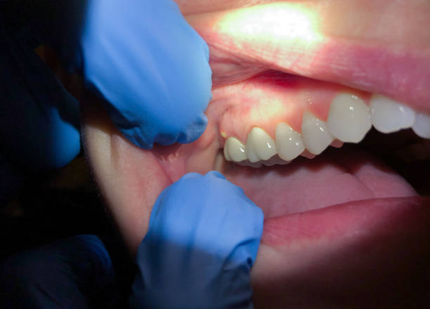 Best Emergency Dental Extractions in Bunker Hill, OR